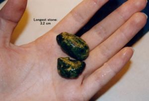 Liver stones